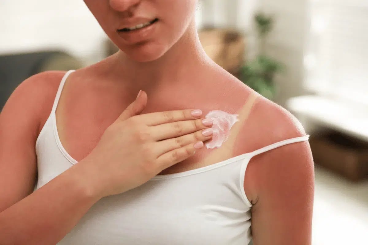 Stock photograph of a model: a woman with sunburned shoulders applies cream