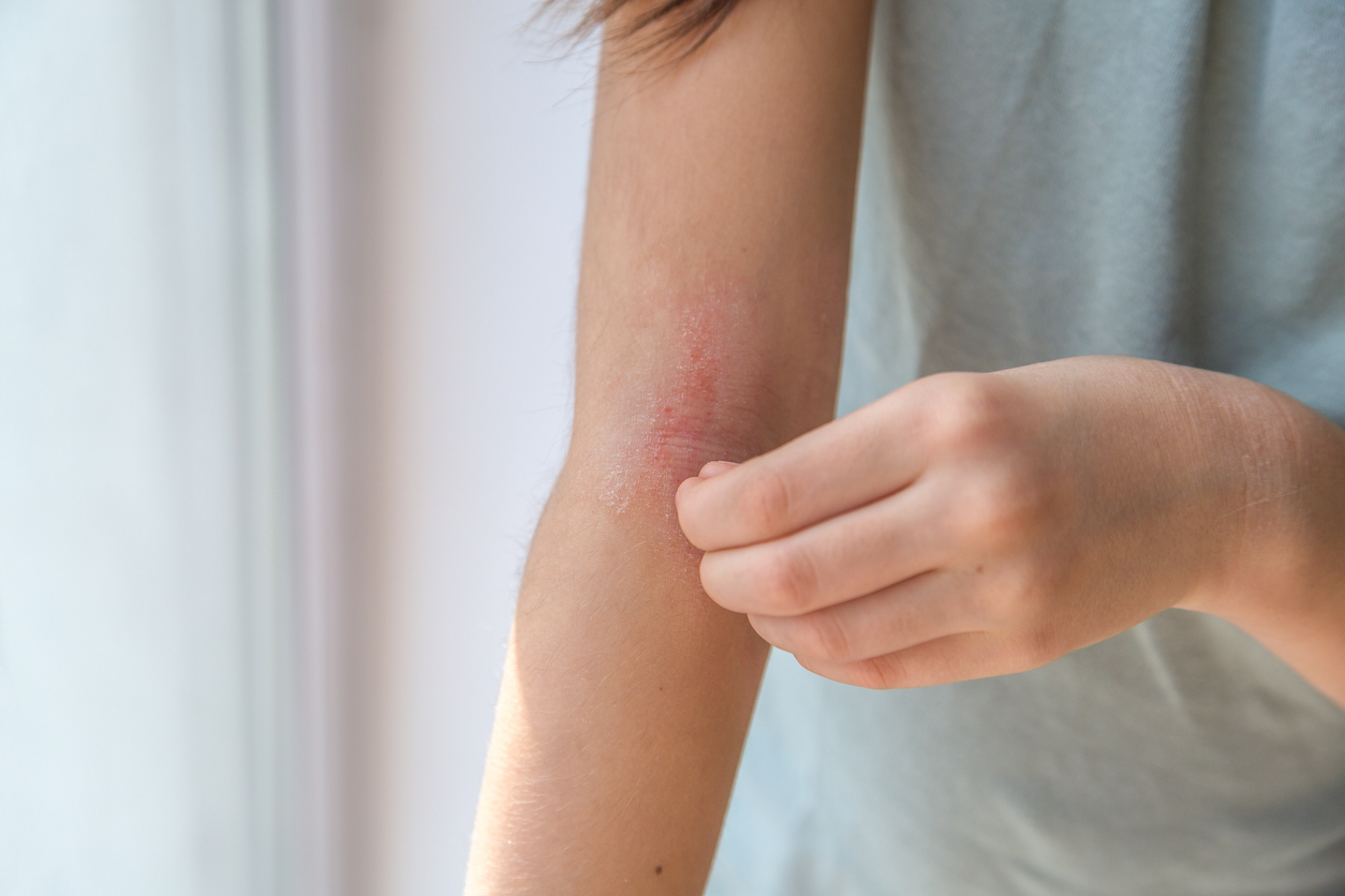 Stock photograph of a model: a person scratches a red, irritated patch of skin on the forearm